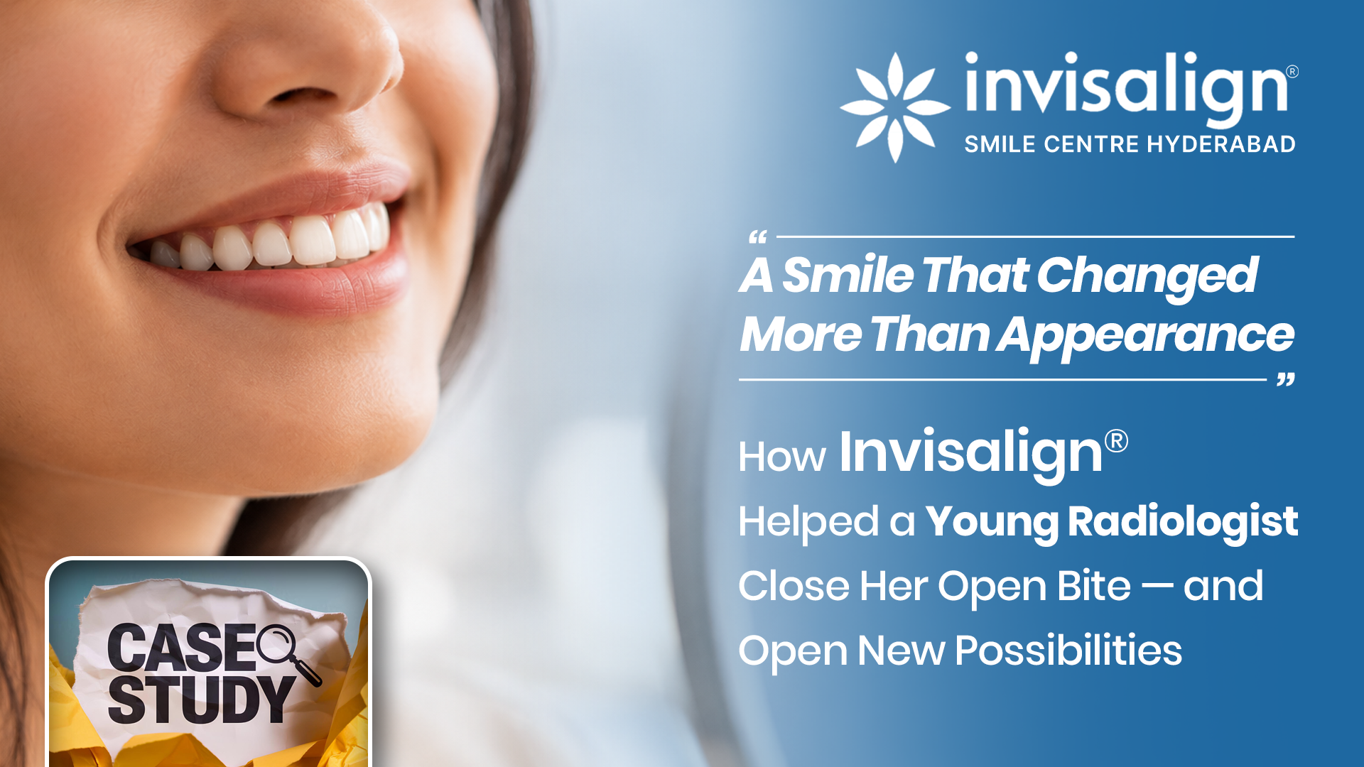 Best Invisalign Treatment in Hyderabad